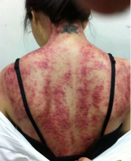 Rücken der Taiwaner Schauspielerin nach einer Gua-Sha-Behandlung